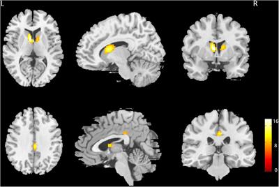 Study of Sex Differences in Unmedicated Patients With Major Depressive Disorder by Using Resting State Brain Functional Magnetic Resonance Imaging